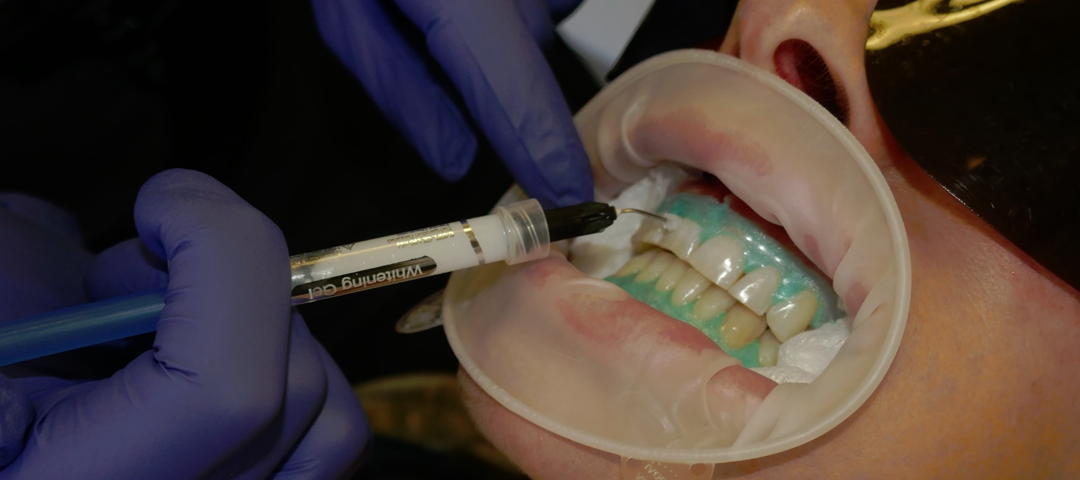 Venus teeth whitening gel being applied in dental clinic