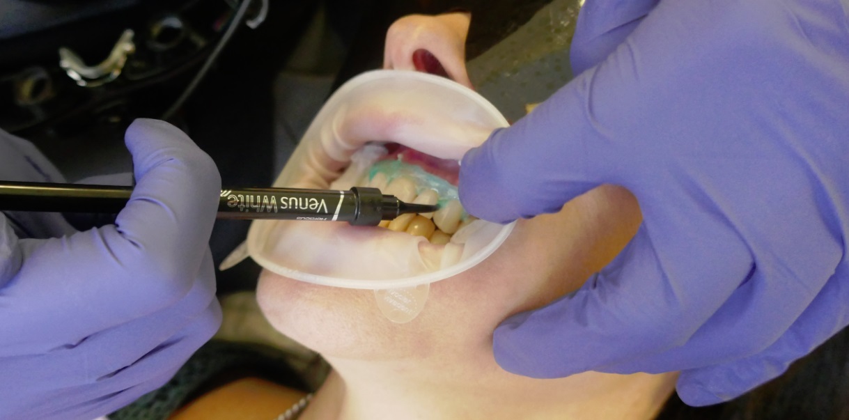ginigival barrier being applied to Laura's gums